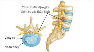 thoát vị đĩa đệm